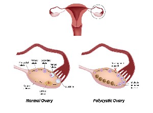 Polycysteus ovariumsyndroom PCOS eierstokcyste